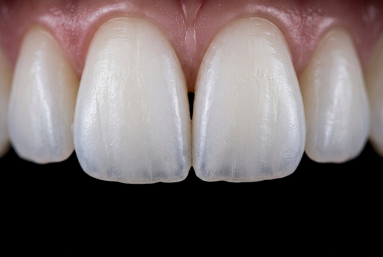 Makro fotografija gornjih zuba kao primjer rezultata na tečaju dentalne fotografije.