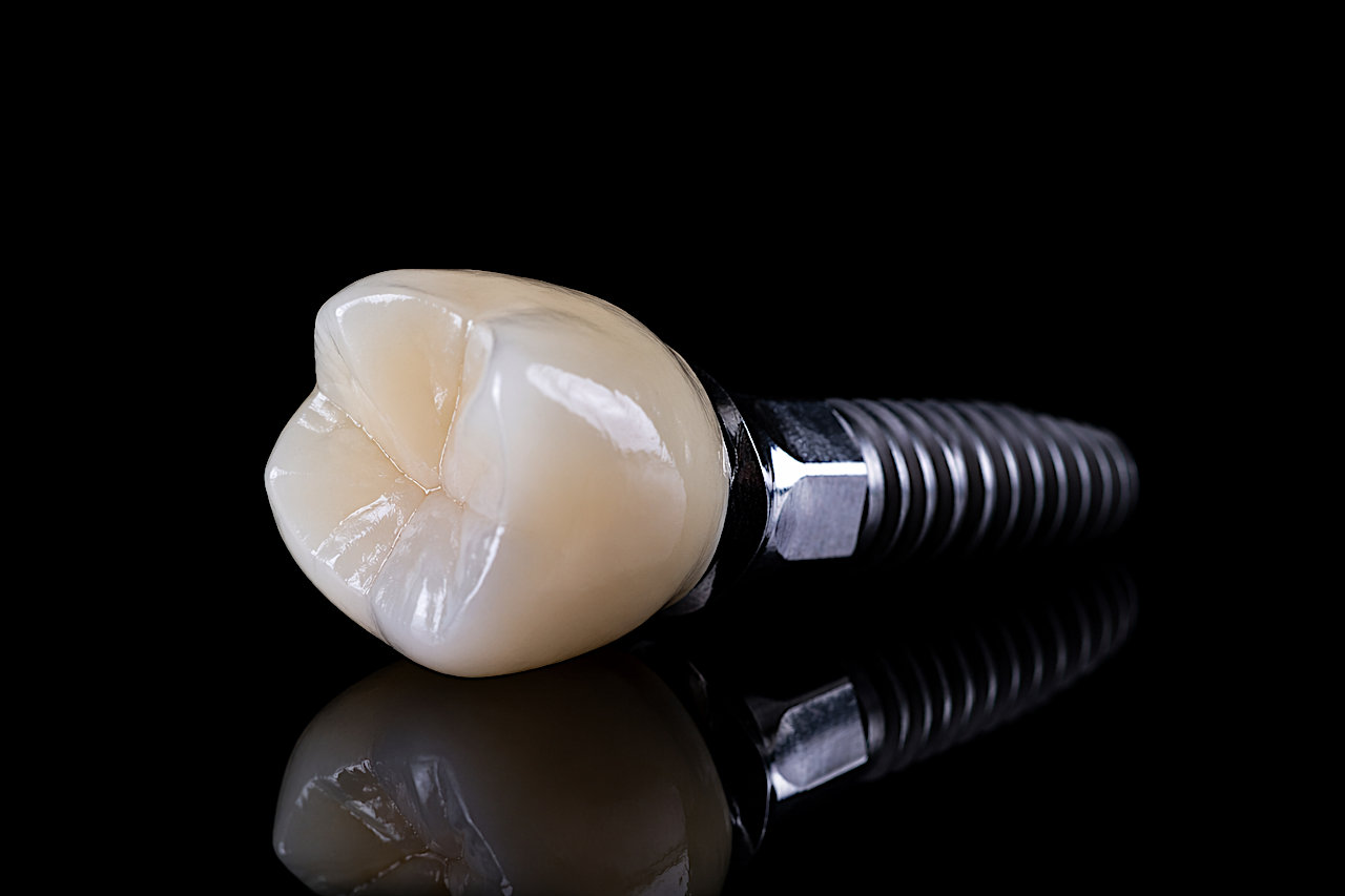 Zubni implantat fotografiran na tečaju dentalne fotografije uz korištenje profesionalne rasvjete i makro objektiva.